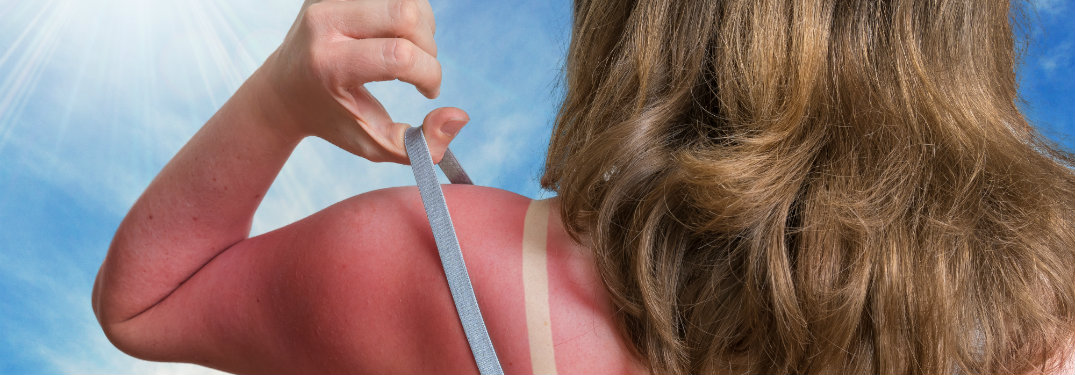 woman with bad sunburn line
